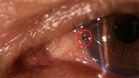 遠距問診　農民眼球鐵屑夾出解除疼痛台東縣成功鎮一名50多歲農民眼睛疼痛，透過遠距醫療儀器，由距離218公里的高雄長庚醫院眼科會診，在眼球找到鐵屑，並順利夾出解除疼痛。（衛生福利部台東醫院提供）中央社記者盧太城台東傳真　108年11月29日