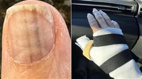 58歲女「指甲冒出2條線」！皮膚科一驗…罹癌了　挖掉手指肉保命（圖／翻攝自IG＠michelletagliamonte）