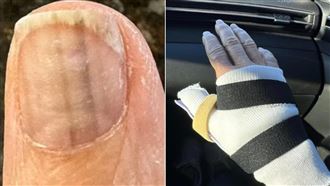 女罹癌「指甲冒出2條線」 挖掉手指肉保命