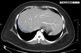 捐肝,肝臟(圖/彰基提供)