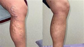 腿上，密密麻麻蚯蚓，38歲男警，靜脈曲張，微創，整形外科郭彥辰醫師(圖／童綜合醫院提供)