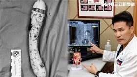 男子照了X光，確認身體裡卡了一支巨大按摩棒。（圖／陳致一醫師提供）