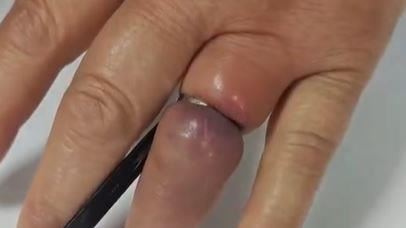 戒指「鑲進肉裡」腫到發紫　消防整個切斷