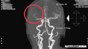 ▲南投醫院腦中風。（圖／南投醫院提供） 