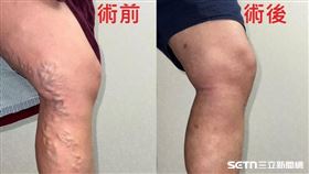 ▲靜脈曲張。（圖／童綜合醫院提供） 