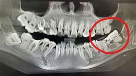 安徽正妹被拔錯牙，痛到輕生。（圖／翻攝自抖音）