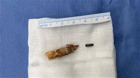 大陸8歲女童彤彤（化名）因被鉛筆刺傷，竟導致了慢性跟骨骨髓炎。（圖／翻攝自長沙晚報）