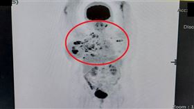 發炎性乳癌的侵襲性高，容易擴展至整個乳房(紅圈處)。（圖／大千綜合醫院提供）