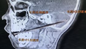 長12公分的竹籤硬生從口腔刺進頭顱。（圖／翻攝自廣州日報）