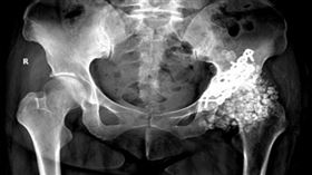 痛到難行！體內取出259顆軟骨瘤　（圖／翻攝自福州晚報）