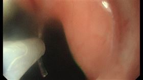 魚刺,內視鏡,喉嚨,喝醋（圖／台北榮總新竹分院提供）