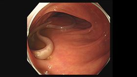 腸胃內科醫師經由大腸鏡檢查在病人腸道中發現蛔蟲。（圖／大林慈濟醫院提供） 