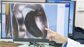 疑患異食癖，拔毛癖，8歲女童腹痛3個月，胃部小腸取出髮結石（圖／彰基醫院提供） 