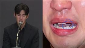 許超醫師說，無法透過一張模糊的照片，去確定金秀賢口中異物是否「菜花」。（圖／翻攝自許超醫師微博）