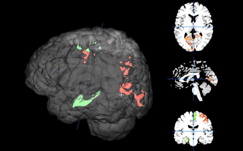 便祕 = 大腦老3歲！研究震撼曝光，若1週排便少於3次，記憶力退化風險會飆73%（示意圖／陽明交大提供）