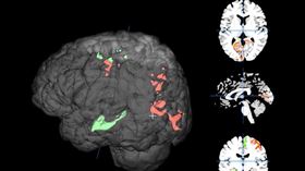 智慧腦影像平台能以個人化的方式定量不同大腦區域結構和功能退化狀況，作為後續診斷及精準腦刺激治療的客觀依據。（圖／陽明交大提供）