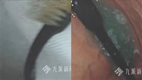 大胃王誤吞整支牙刷。（圖／翻攝自微博）