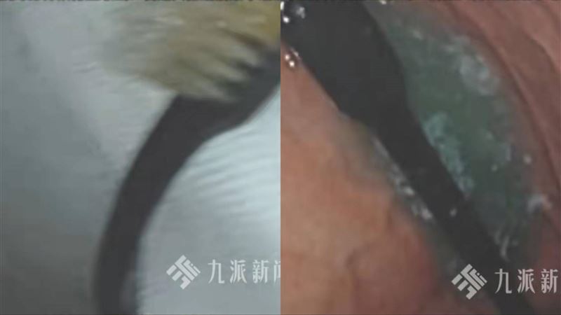 大胃王網紅催吐誤吞牙刷　送醫搶救現況曝