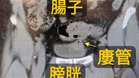 60歲男驚見泡泡尿　醫一看：腸子通到膀胱（圖／翻攝自戴定恩臉書）