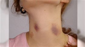 急診,男友,醫生,缺血性腦中風（示意圖／翻攝維基百科）