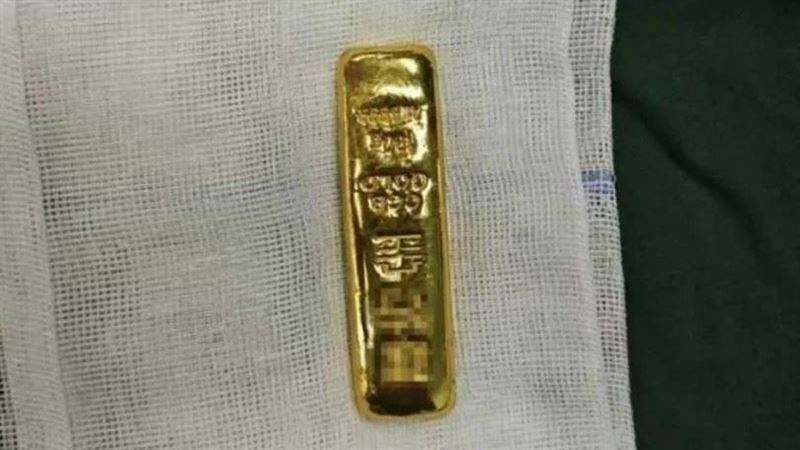 11歲弟腹脹送醫！ 醫取出100克金條傻眼
