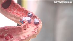 大腸癌 直腸癌 住院 醫院 示意圖／資料照