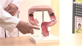 大腸癌 直腸癌 住院 醫院 示意圖／資料照