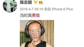 陳志朋曾發照曝光臉燒傷的狀況（圖／翻攝微博）