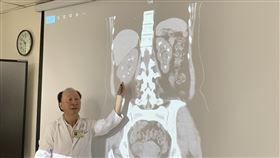 2年內5度腎結石復發，雙腎如「滿天星」，副甲狀腺機能亢進，切除，(圖／臺中醫院提供)