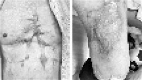 氣爆,燒傷(陽光基金會 提供)