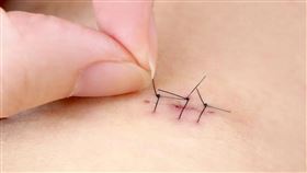 印度一名男子因腹痛難耐，居然從YouTube自學開刀，在家自行開腹手術並縫合。（示意圖／翻攝自photoAC）