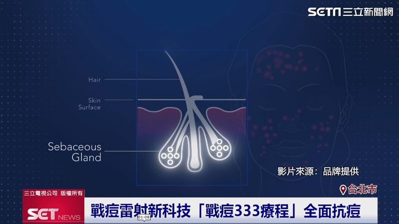 青春痘源於皮脂腺過度分泌油脂，造成毛孔阻塞並引發發炎。 （圖／截自影片）