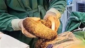 經過手術，醫師從女童腹中取出毛髮結石。（圖／翻攝自微博）