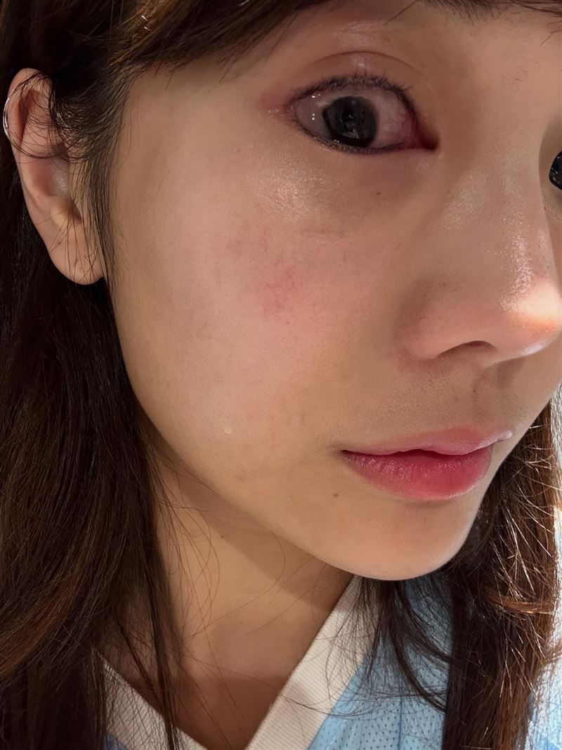 琳妲的眼睛出現明顯紅腫。（圖／翻攝自Thread @linda831212）
