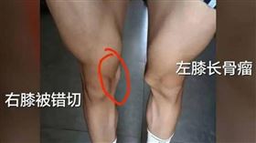 體育生左膝長骨瘤！醫錯切右膝　母怒發聲