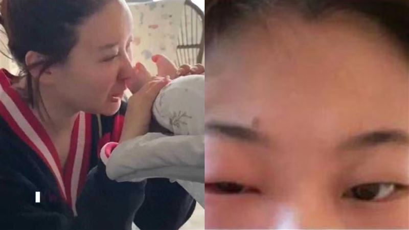 女星聞寶寶腳丫　眼睛感染「腫到睜不開」