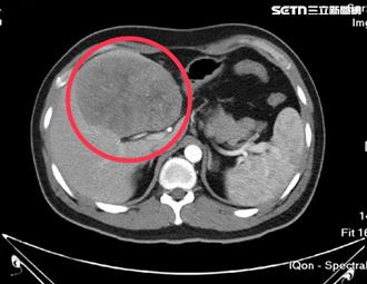 33歲男解黑便吐血　醫一看11cm嘆晚期了