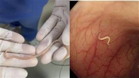 中國深圳,腹痛,腸道,活體蛔蟲（圖／翻攝自南方都市報）