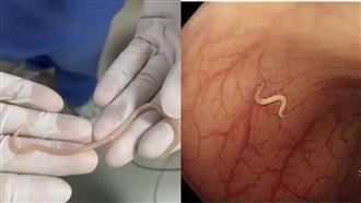 女腹痛夾出10公分活體寄生蟲！染病原因曝