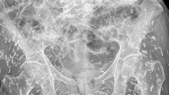 婦照X光「體內佈滿白點」　恐怖真相曝光