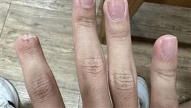 員警上班遇三寶，食指慘遭截肢。（圖／警方提供）