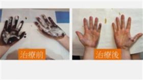 吹冷氣也狂噴汗！15歲妹「身飄異味」羞愧躲同學 手抹1物秒冒紫斑（微博）