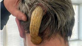 ▲ 男子後腦杓突然長出一根約12公分「惡魔角」。（圖／翻攝自X）