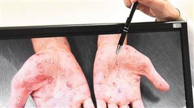 梅毒症狀很複雜，部分患者初期毫無症狀，直到二期才會出現全身紅疹，若不及時治療，惡化至晚期甚至可能導致全身癱瘓。（示意圖／CTWANT）