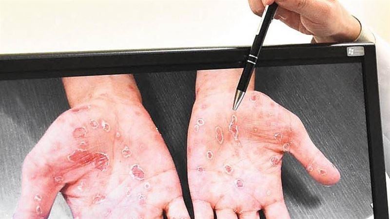 兒少性病爆增　專家揭「這原因」