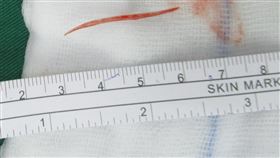 男子魚刺穿出胃部造成膽囊發炎48歲王姓男子因腹痛前往部立彰化醫院掛急診，醫師發現，王男腹內有3公分長魚刺穿出胃部，穿孔處雖已癒合，膿瘍卻壓迫膽囊及膽道系統，造成膽囊發炎。（彰化醫院提供）中央社記者吳哲豪傳真  111年7月12日