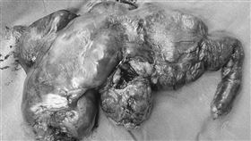 ▲醫師手術切開發現很多脂肪般的肉球，及軟便和很大的憇室，標本大概重約2.5公斤。（圖／中山醫院提供）