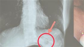 台中60歲女，拔鼻胃管，痛到扭曲，一照X光發現，鼻胃管打結(圖／臺中醫院提供)