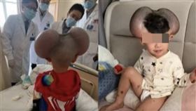 3歲童罹罕病成「米奇」手術移除終於笑了