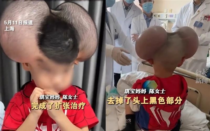 3歲娃頭頂米奇巨痣　手術驚險摘除獲新生